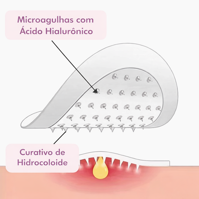 Acabe com Espinhas sem Deixar Manchas