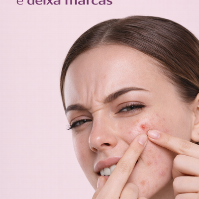 Acabe com Espinhas sem Deixar Manchas