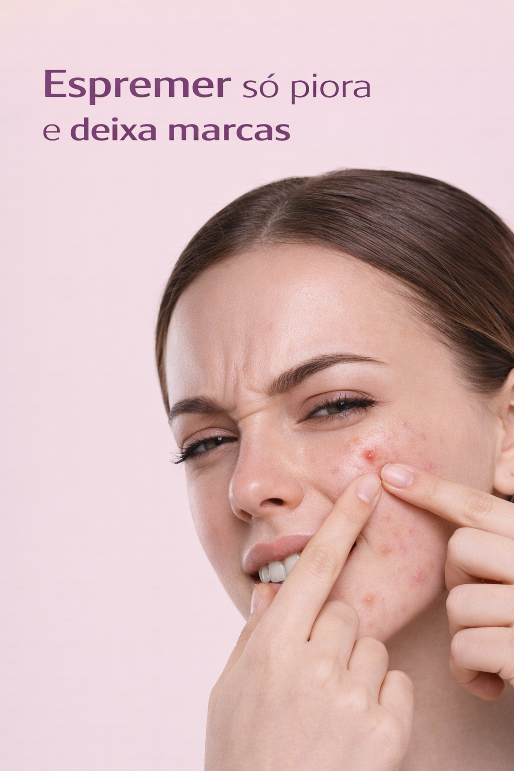 Acabe com Espinhas sem Deixar Manchas